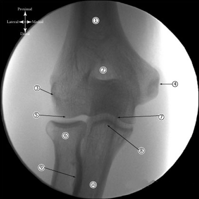 A/P Elbow Xray - Forearm in suppination 1. Humeral Shaft 2. Olecranon fossa 3. Lateral epicondyle 4.