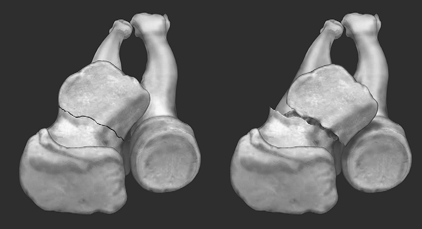 Type 3 basal