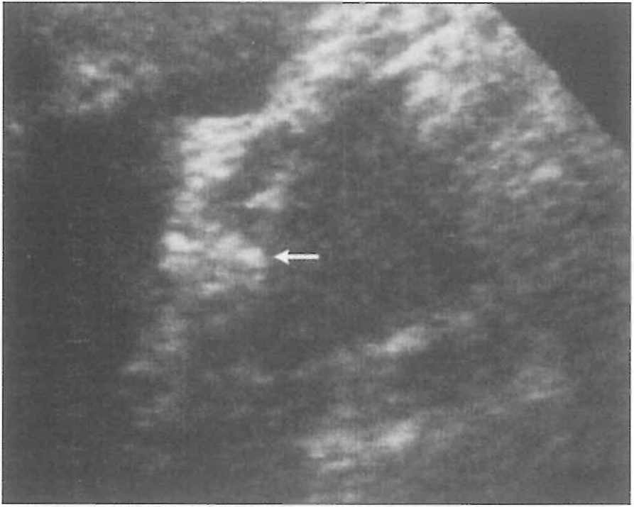 Ultrasonografi Kılavuzluğunda Pankreas İğne Biyopsileri Yetersiz materyal Endokrin tümör Pankreatit Epitelyal tümör Bening Şüpheli malign Müsinöz Adenokarsinom indiferansiye Malign Malign epitelyal