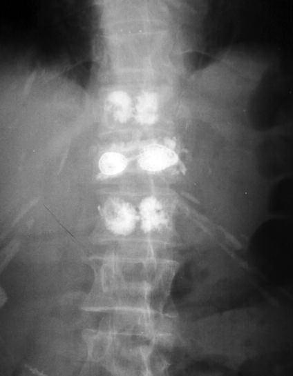 Şekil-2. (b) Bir olgunun ameliyat sonrası anteroposterior ve (b) lateral radyografik görüntüsü. Tablo-1. Vertebroplasti ve kifopasti yapılan olguların karşılaştırılması.