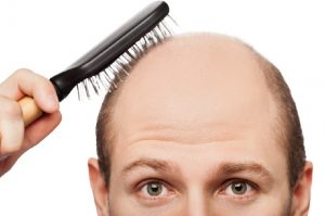 Saç Dökülmesi ve Çözüm Yolları Saç Dökülmesi ve Çözüm Yolları yazımızda çoğunlukla erkeklerde görülen yoğun saç dökülmesi ve bununla birlikte kellik oluşması, saçların belirli zamanlar dökülmesi
