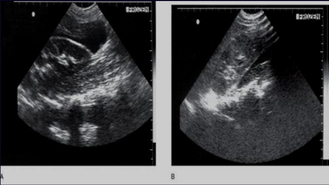 Ultrasonografi (FAST) Peritonda serbest sıvı araştırılır 1. Subksifoid görüntü (Perikardiyal sıvı) 2.