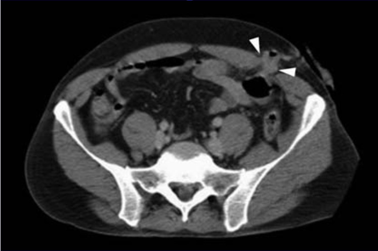 Laparoskopi Periton penetrasyonu ve diyafragma yaralanmasının tanısında altın