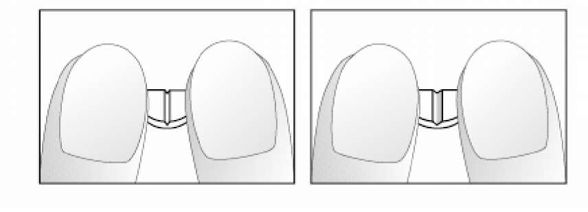Şekil 1 ve 2: NEXİVOL çift-çentikli tabletin kolaylıkla kırılarak yarıya bölünmesi.