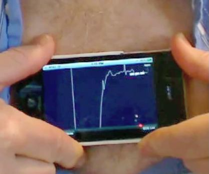 Kaynaklar: iphoneecg Stephen Smith, MD