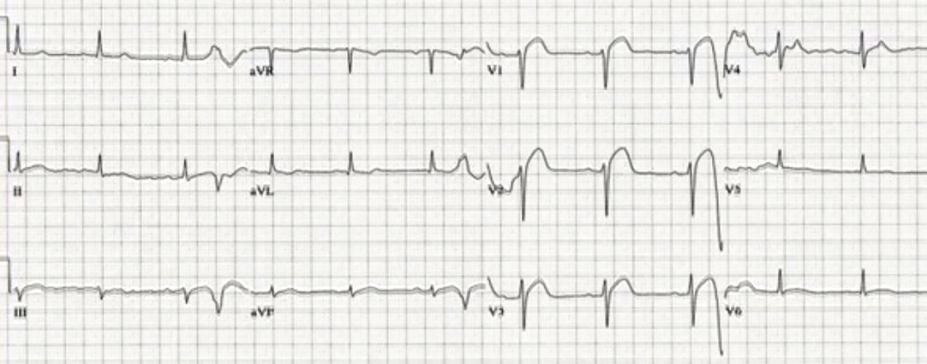 4. olgu Bir ay önce çekilmiş EKG 4. olgu Tekrarlayan enzimler normal Taburcu Bekleme salonunda 45 dk Oradayken tekrar göğüs ağrısı, terleme, bayılma hissi 4. olgu 4.