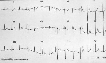 Plevral Efüzyonun Elektrokardiyografi (EKG) Üzerine Etkileri Çalışmanın istatistiki analizleri Wilcoxon signed rank sum testi kullanılarak kalp ritmi, aks değişiklikleri, P, Q, R, S, T dalgalarının