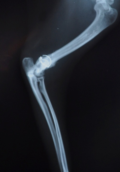 Şekil : Olgu no. 2 nin preoperatif ve postoperatif A/P ve M/L radyografik görünümleri Figure : Preoperative and postoperative A/P and M/L radiological views of Case no. 2 Şekil 2: Olgu no.