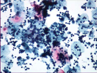 Pamukkale Tıp Dergisi 2011;4(3):119-123 Vanlı ve ark. hastalardan 157 sine ait biyopsi materyalinin mevcut olduğu patoloji raporlarından saptandı.