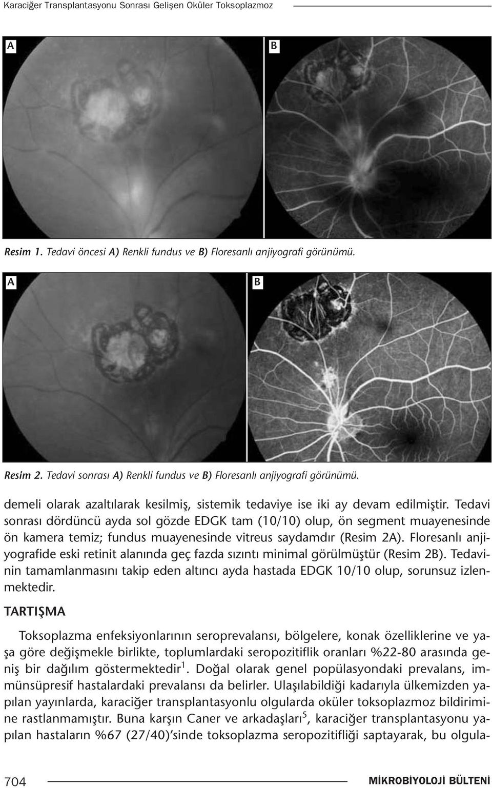 Tedavi sonrası dördüncü ayda sol gözde EDGK tam (10/10) olup, ön segment muayenesinde ön kamera temiz; fundus muayenesinde vitreus saydamdır (Resim 2A).