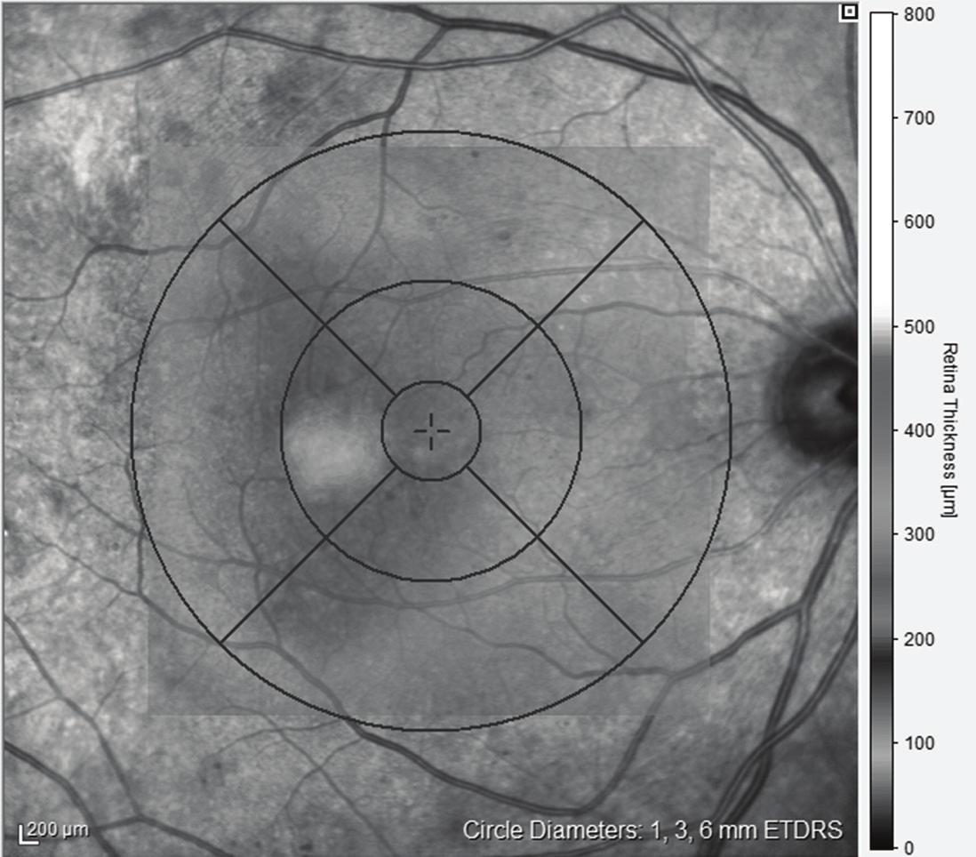 262 Diyabetik Maküler Ödemi Olan Hastalarda İntravitreal Triamsinolon... Resim 4: Optik koherens tomografi ile alınan hızlı maküla kalınlığı ölçüm modu ile hesaplanan maküla hacmi görüntüsü.