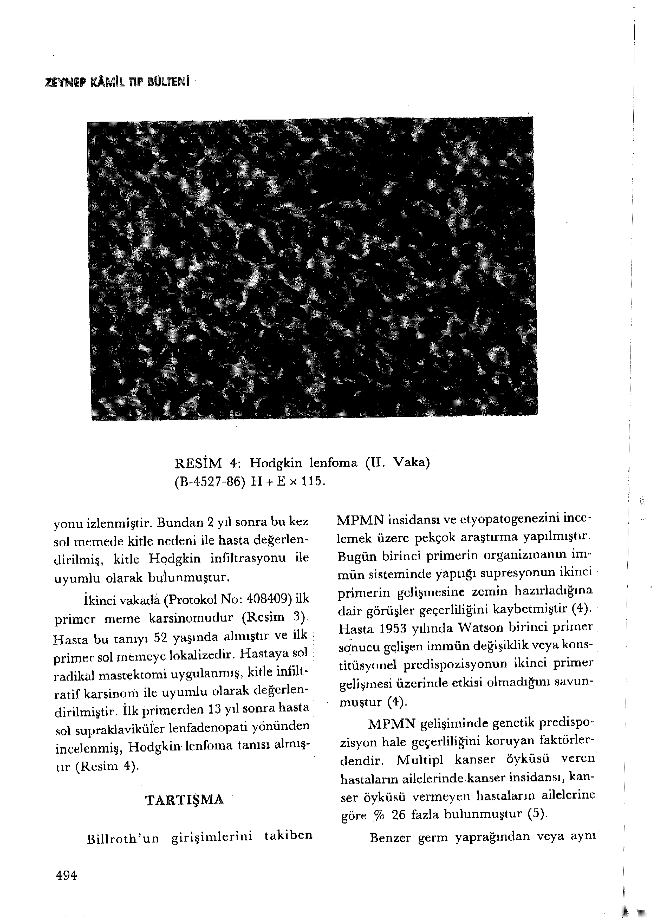 KAMiL TIP IÜLTENI. RESİM 4: Hodgkin lenfoma (II. Vaka) (B-4527-86) H + E x 115. yonu izlenmiştir.