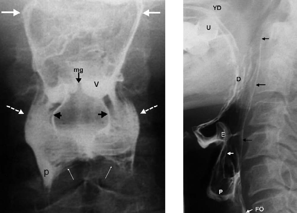 A Resim 2. Normal farinks. A, Ön-arka farinks radyogramında, orta hatta median glossoepiglottik kıvrımla (mg) birbirinden ayrılmış kap şeklinde iki taraflı vallekulalar (v: sol vallekula) görülüyor.