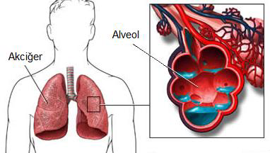 Pulmoner Ödem Akciğerler kan damarlarındaki basınç, çeşitli nedenlerle normalin üstüne çıkar. Bu aşırı yükselme kılcal damarlar içindeki kanın alveoller içine girmesine neden olur.