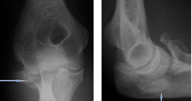 Konservatif Tedavinin Kontrendike Olduğu Durumlar: 3. Floating elbow Erişkin ön kol kırıklarında cerrahi tedavi önerilmektedir.