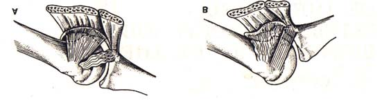 Şekil 3. Art. metacarpophalangea pollicis (transversal kesit). 1) m. adductor pollicis, 2) m. adductor pollicis in dorsal aponevrozu, 3) m. abductor pollicis brevis, 4 ve 5) m.