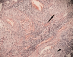 Parotis bezinin primer epidermoid karsinomu 3. bölgeden ay klanan 3 ünde epidermoid hücreli karsinom metastaz saptand. Hastaya postoperatif radyoterapi tedavisi uyguland.