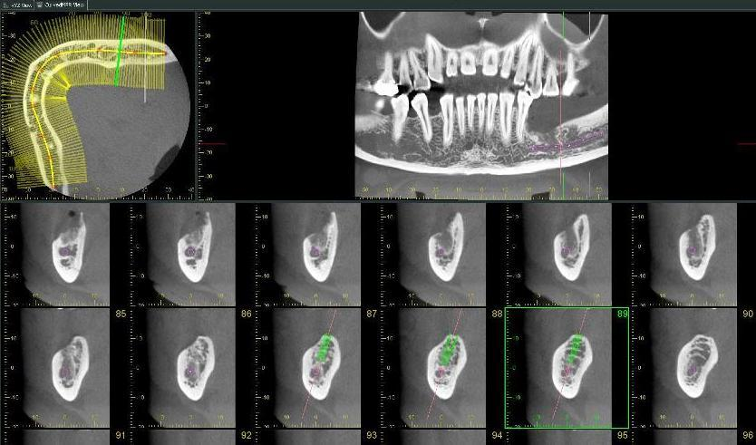 Kullanıcı Dostu Yeni Yazılım Curved MPR: Kesitler dental ark boyunca ortagonal olarak izlenebilir.