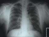 Hedef 2: Steril İnflamasyonu ya da İnfeksiyon Dışı Anormal X-Ray Bulgularını AB ile Tedavi Etme TKP: Çoğunlukla tanısı zordur