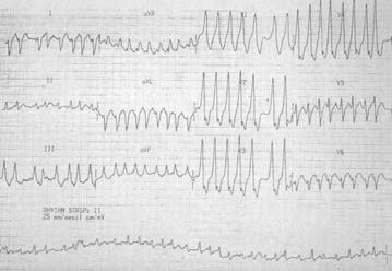 37 38 AF+WPW 39 40 Stabil geniş kompleks taşikardiler EKG kriterleri Geniş QRS kompleks taşiaritmiler 41 RR intervali çok az değişir. Hız: > 100 tipik olarak 120-250/dak. Ritm: QRS 0.12 sn.