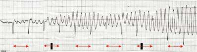 FM - EKG EKG monitörizasyonu hemen başlatılmalıdır Tüm defibrilatörler paddle modunda açılırlar ve bu esnada kaşıklar göğüse yapıştırılarak da ritim görülebilir, defibrile edilebilir Özellikle hızlı