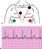 Uzm. Dr. Haldun Akoğlu Sistematik Ritim Değerlendirme 1. QRS kompleksleri dar mı geniş mi (>0.12 sn)? 2. Ventrikül hızı düzenli şekilde mi yoksa düzensiz şekilde mi irregüler? 3.