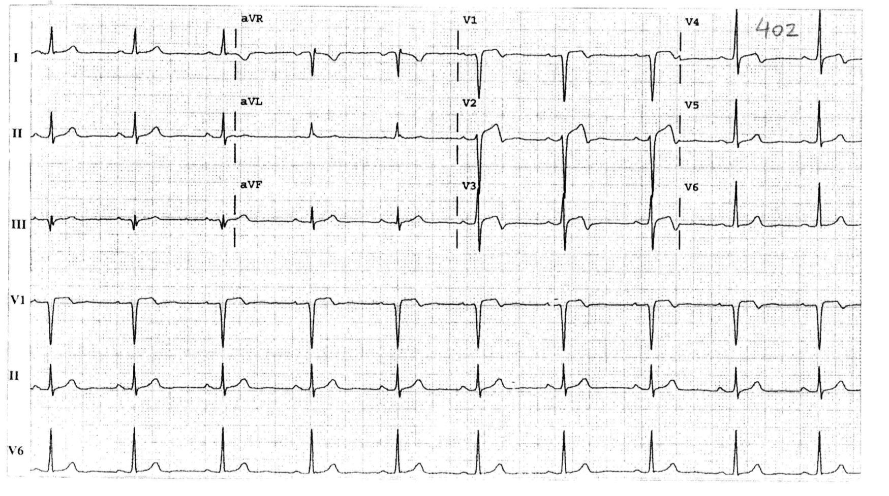 54 y erkek. 2-3 gündür olup geçen göğüs ağrılarından yakınıyor. EKG bulgularına göre yöneliminiz nasıl olur? 402 1) EKG normaldir.