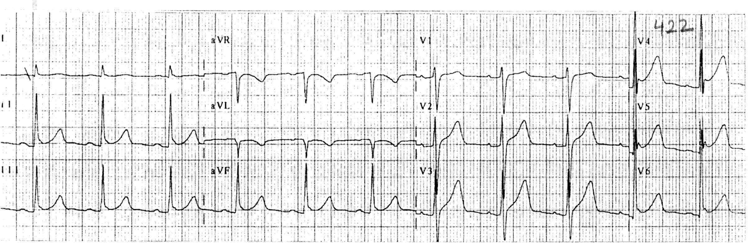 33 y erkek. Batıcı, saniyelik göğüs ağrılarından yakınıyor. EKG bulgularına göre hangisini ilk planda DÜŞÜNMEZSİNİZ?