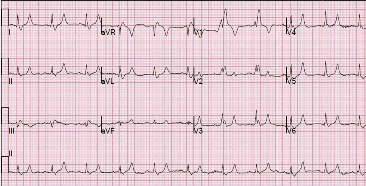 EKG bulgunuz nedir?