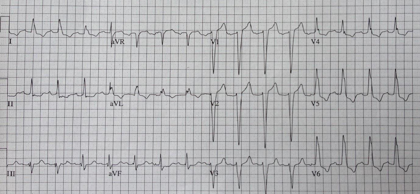 EKG bulgunuz nedir?