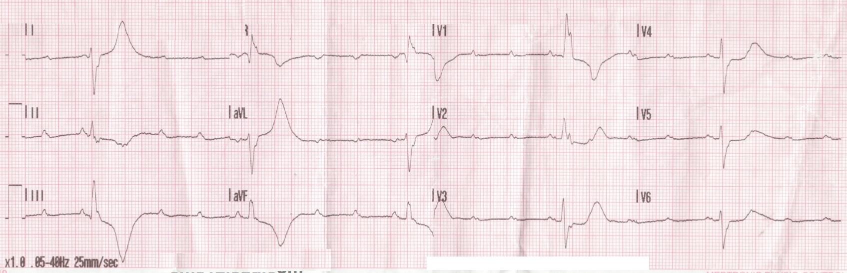 EKG bulgunuz nedir?