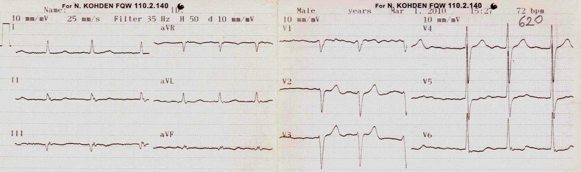 EKG bulgunuz nedir?