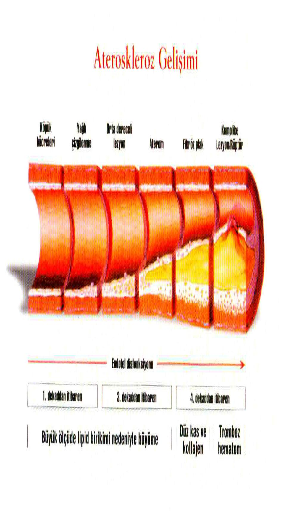 kardiyovasküler olayların anlamlı bir şekilde azalması inflamasyonu yatıştırmanın ne kadar önemli olduğunu gösteren bir kanıttır (34) Şekil 2 : Koroner aterosklerotik plağın oluşumu ve ilerlemesi