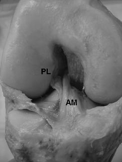 4 ve benzer lokalizasyonda yerleştirilmesidir. ÖÇB tibiada, anterior eminensiyanın ön ve lateralinde yer alan fossaya yapışır (8). Femoral yapışma alanı yaklaşık 2-2.