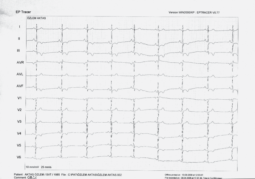 120 Türk Aritmi, Pacemaker ve Elektrofizyoloji Dergisi ŞEKİL 3 Hastanın işlem sonrasında normal sinüs ritmindeki EKG örneği.
