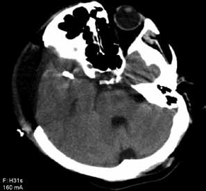 a b c d Şekil 4: A,B) Sağ silvian sistende hematom + SAK görüntüsü + hidrosefali. C) Sağ OSA da anevrizma. D) Postop CT Anevrizma kliplenmiş ve dekompressif kraniektomi mevcut.