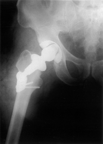 36 Acta Orthop Traumatol Turc Plakl kalça protezi (thrust plate prosthesis) (Sulzer, Baar, Switzerland), proksimal femurun metafizinde çimentosuz ve femurun medullas na oyma ifllemi yap lmadan