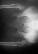 Resim a..5 yaþýnda bilateral kalça dislokasyonlu kýz çocuðunun preoperatif radyografisi. b. Ayný hastanýn operasyondan yýl sonraki radyolojik görünümü.