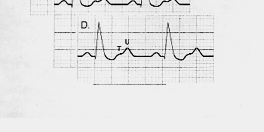 Şiddetli Hiperkalemi ( >7 meq/lt ve toksik EKG değişikliği) Potasyumu hücre içine gönder Kalsiyum Klorid (%10 CaCl), 5-10 ml >2-5 dak VF riskini azaltır NaHCO 3 50 meq, >5 dak (KBY de daha az etkili)