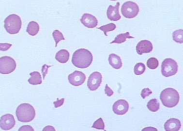 Laboratuar : Üre: 132 mg/dl, kreatinin: 3.4 mg/dl, LDH: 4691 U/L, Hemoglobin: 9.9 g/dl, trombosit 26.400/mm 3, haptoglobin: 22.