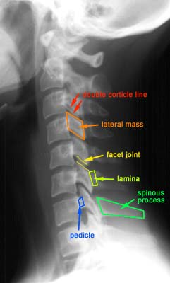 3 mm den az 12 mm den az Lateral grafi C3-C7 vertebralar arası Vertebra cisimleri genelde dikdörtgen ve Lordotik görünüm Vertebra cisimlerinin posterior yüzleri, spinal kanalın anterior duvarını