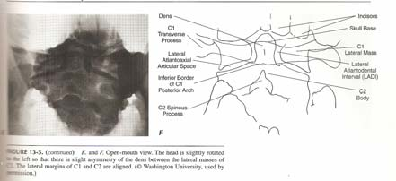 Lateral grafi Nazogastrik takıldığında yada entübe edildiğinde yumuşak doku gölgesi artar Prevertebral yumuşak dokuda anormal genişleme gizli servikal vertebra yaralanmasını gösterir Özellikle