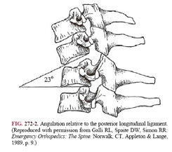 Vertebral cisimde yer değiştirme yada açılanma yaralanmayı düşündürür Bitişik İki vertebra arasında 3,5 mm lik fark instabliteyi düşündürür Bitişik iki vertebra superior kısımları arasındaki açı 11