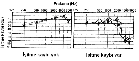 Gürültünün fizyolojik etkileri -İşitme kayıpları- Akustik Travma Grafikte görülen odyogramda, gürültü
