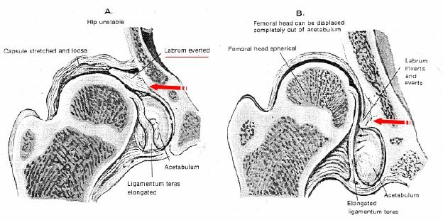 26 2.8. Asetabuler Displazi Doğumda normal kalçada femur başı ile asetabulum arasında sıkı uyum vardır.