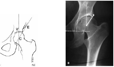 39 olmalıdır. Trokanter majör nötral pozisyonda femur boynunun yanında yer almakta iken aşırı anteversiyonda femur boynu ile üst üste görünebilmektedir.