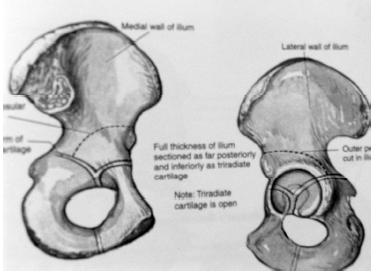 66 2.8.3.4.3.1. Pemberton osteotomisi (Perikapsüler osteotomi) Pemberton (1965) tarafından tarif edilmiştir. Y kıkırdağından dönen inkomplet osteotomidir.