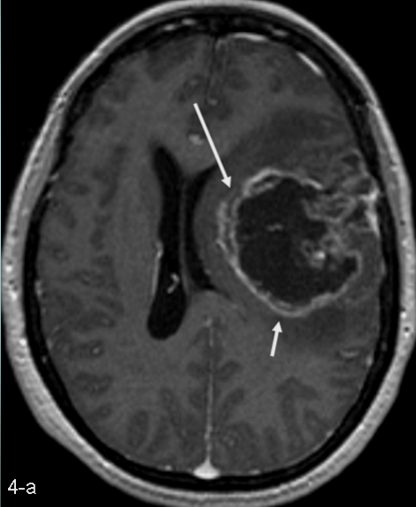 TP53 pozitif GBM (%23) Dr.