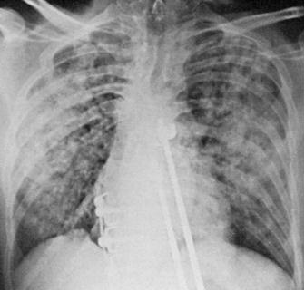 Varicella-Zoster Virus (VZV) Akciğer Grafisi: Diffüz noduler infiltrasyon, Hiler