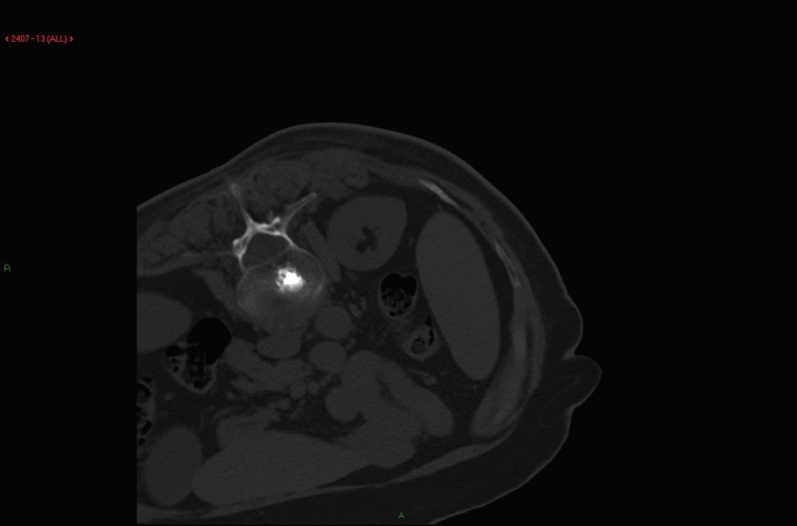 Vertebroplasti